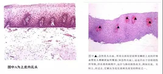 食管表浅癌浸润有多“深”?关键看你食管病理知识掌握了几分 食管表浅癌浸润有多“深”?关键看你食管病理知识掌握了几分