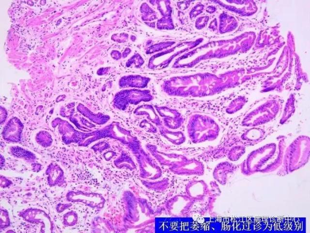 上消化道低级别上皮内瘤变的那些事
