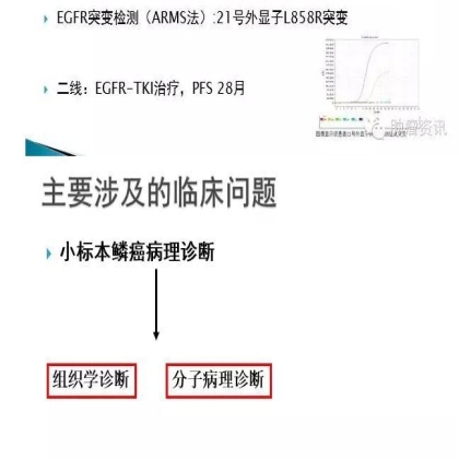 中日韩个体化诊疗案例大赛经典赏析之三——鳞癌诊断需警惕，二次活检为肺腺癌，EGFR 21exon突变，二线TKIPFS28月