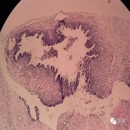 交界性黏液性囊腺瘤？癌？（魏娉分享，刘从容老师讲解）