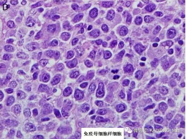 T细胞淋巴瘤病理诊断及进展（二）