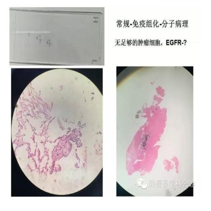 EGFR基因突变检测--基础篇