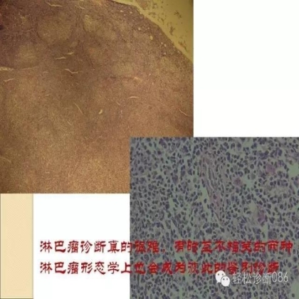 滤泡性淋巴瘤