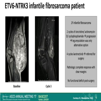 The efficacy of LOXO-101,a selective TRKI, in adult and pediatric TRK fusion cancers