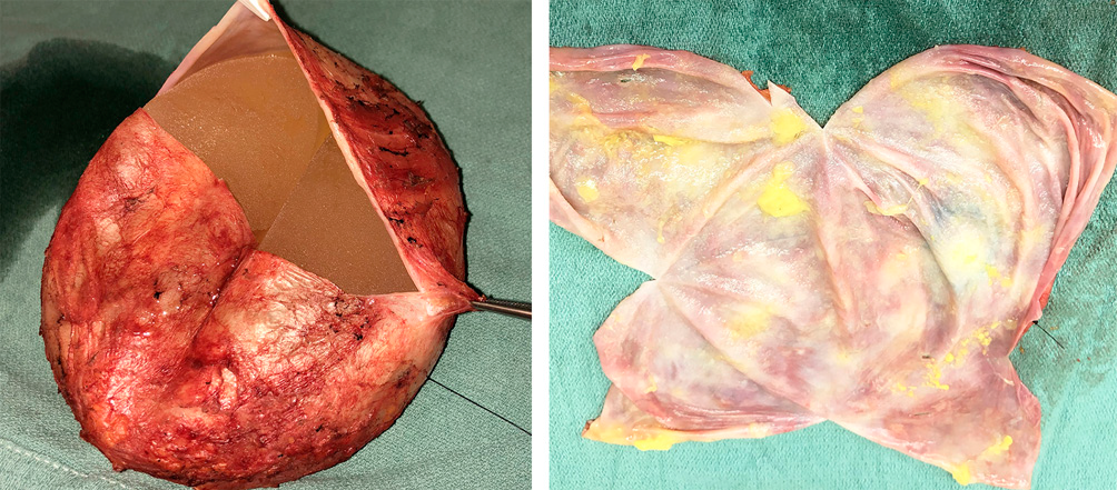 乳腺假体相关的ALCL最佳实用指南（三）