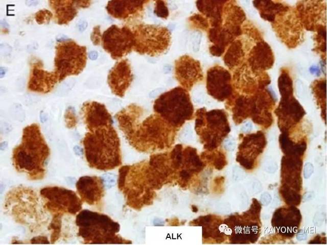 T细胞淋巴瘤病理诊断及进展（一）
