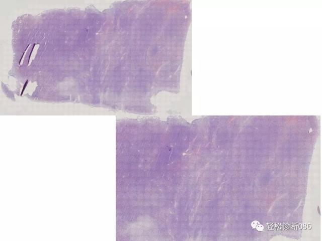 BPDCN病例分享