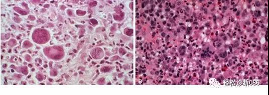 皮肤淋巴瘤(7)——T-NHL（CD30+LPD）