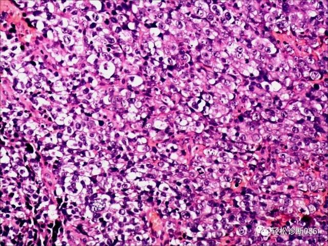 HIV/AIDS相关性LPDHIV感染相关淋巴瘤病例分析