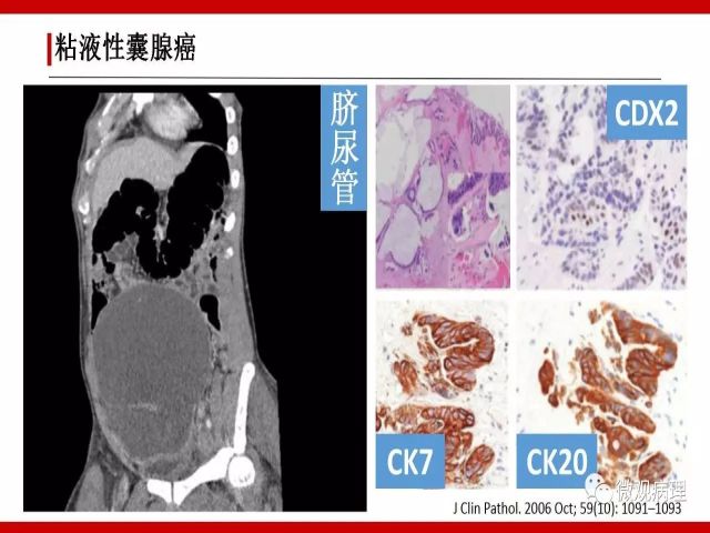 泌尿课程/尿路腺样病变的诊断要点