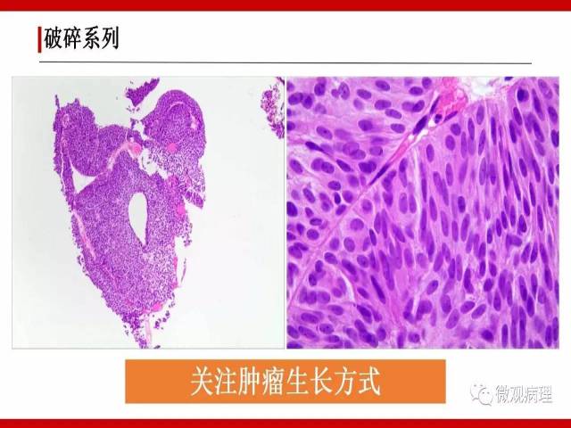 泌尿课程/非浸润性尿路上皮病变诊断的一些困惑