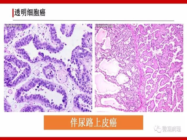 泌尿课程/尿路腺样病变的诊断要点