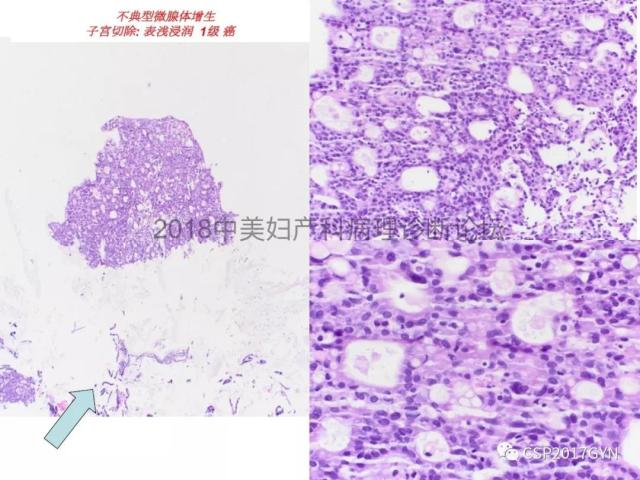 子宫内膜假肿瘤性病变及类似癌样病变