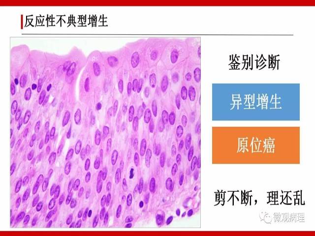 泌尿课程/非浸润性尿路上皮病变诊断的一些困惑