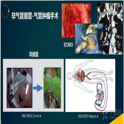 2015年肺癌领域前沿进展