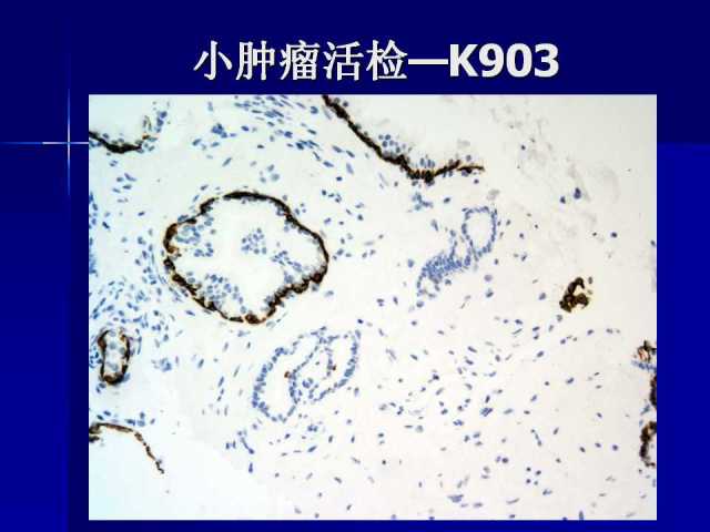 前列腺病理诊断线索（下）——黄教悌