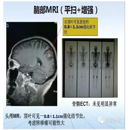 中日韩个体化诊疗案例大赛经典赏析之二——TKI治疗耐药二次活检发现SCLC转化临床病例