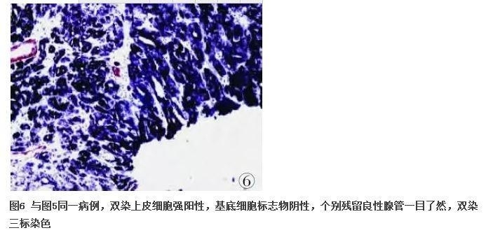 前列腺疾病的免疫组化诊断