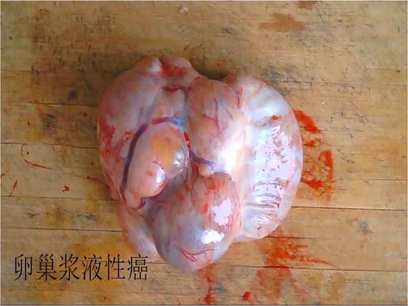 巨大卵巢癌（札记六十一）