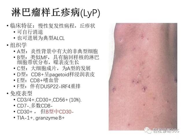 皮肤T细胞淋巴瘤