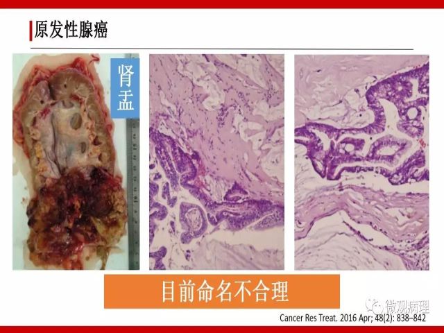 泌尿课程/尿路腺样病变的诊断要点