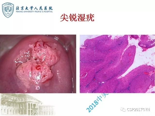 宫颈鳞状上皮内病变病理诊断中问题