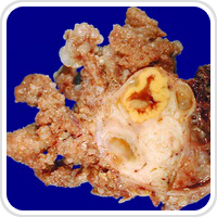Webpathology.com-镜像翻译（自学使用，版权归原网站所有）