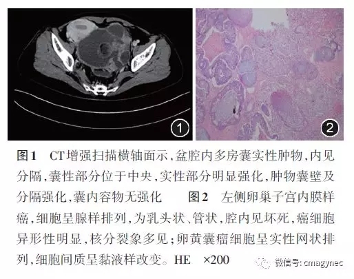 左侧卵巢转移性子宫内膜样癌伴卵黄囊瘤分化一例