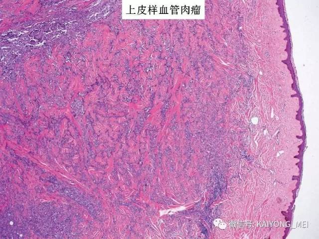 乳腺梭形细胞病变的病理诊断及进展（二）