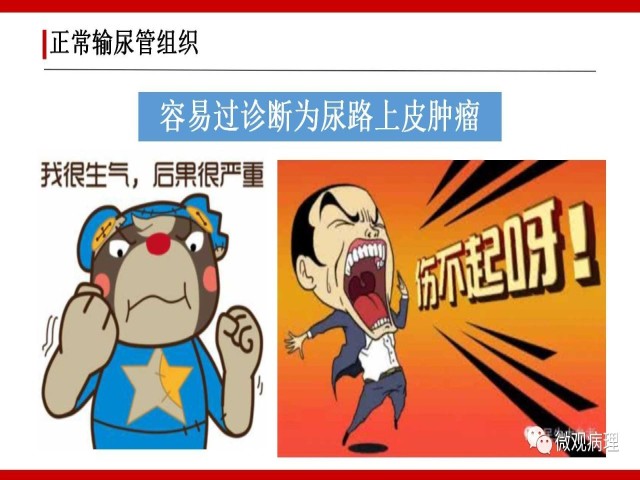 泌尿课程/非浸润性尿路上皮病变诊断的一些困惑