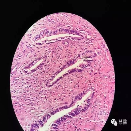 子宫腺肉瘤【吴梅娟】分享；【刘从容】老师讲解）