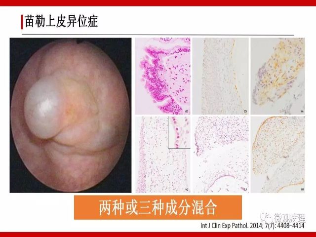 泌尿课程/尿路腺样病变的诊断要点