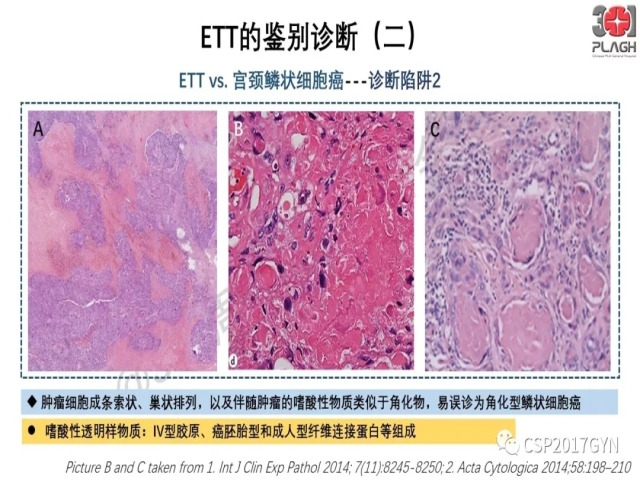 中间型滋养细胞肿瘤的诊断及鉴别诊断