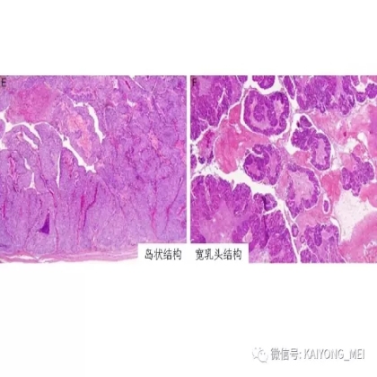 卵巢癌的病理诊断新进展（二）