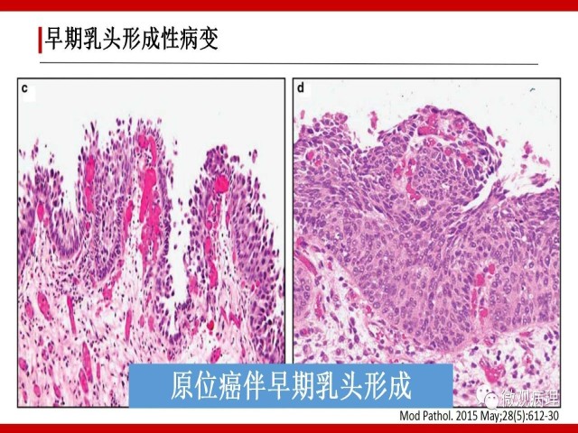 泌尿课程/尿路上皮病变的基本生长方式