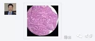 结、直肠管绒毛状腺瘤-高级别病变诊断等相关问题2（悄悄分享、孔祥田(Max)*Roswell*老师讲解）