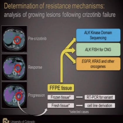 Analysis of resistance mechanisms to ALK kinase inhibitors in ALK+ NSCLC patients