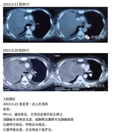 中日韩个体化诊疗案例大赛经典赏析之十四——27岁晚期NSCLC，精准治疗 与 指南盲区向左向右