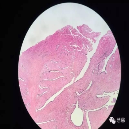 子宫腺肉瘤【吴梅娟】分享；【刘从容】老师讲解）