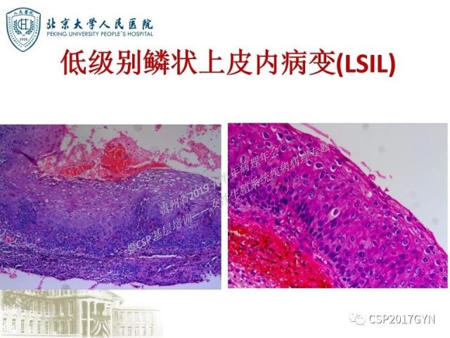 中华病理学会基层培训遵义站讲座（三）——宫颈鳞状上皮病变的病理诊断与鉴别诊断