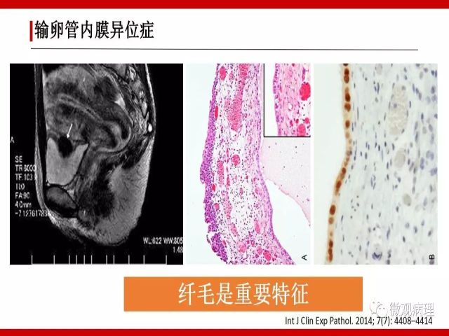 泌尿课程/尿路腺样病变的诊断要点