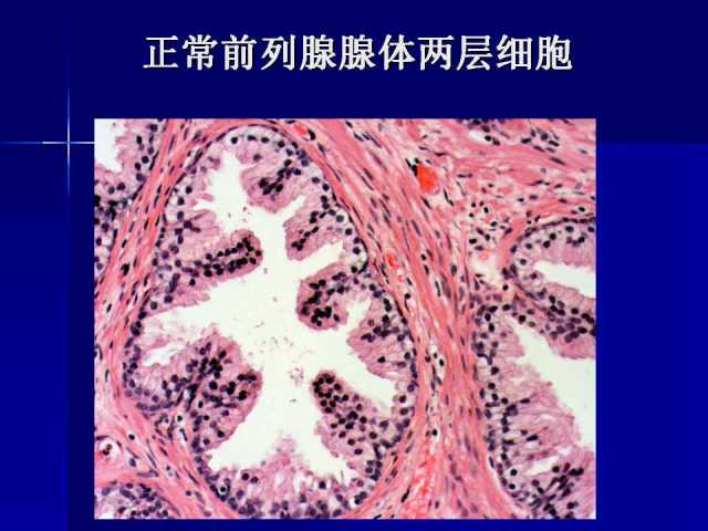 前列腺病理诊断线索（上）——黄教悌