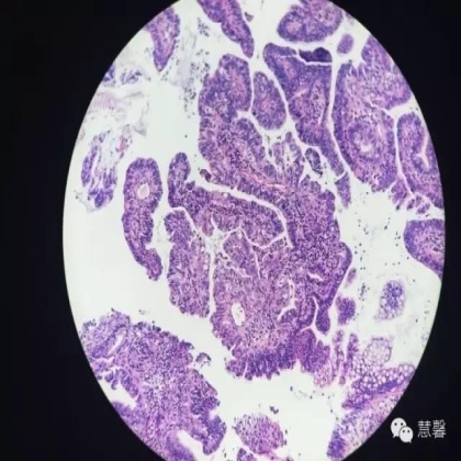 宫颈绒毛状腺癌诊断及相关问题（沈苗分享病例，刘从容老师讲解）