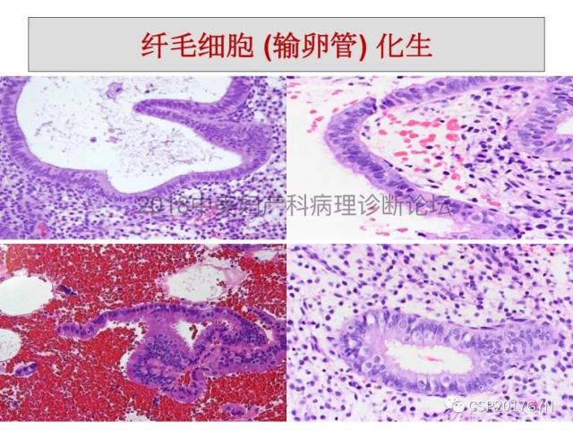 子宫内膜假肿瘤性病变及类似癌样病变