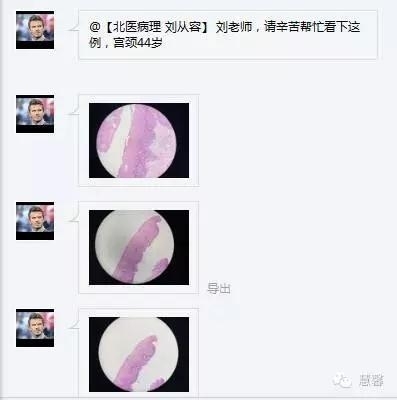 HPV感染挖空细胞形成的机制及其与对SIL级别判断的影响（孔令英分享病例，刘从容老师讲解）