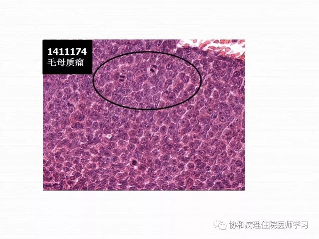病理学基础知识 : 核分裂像的识别