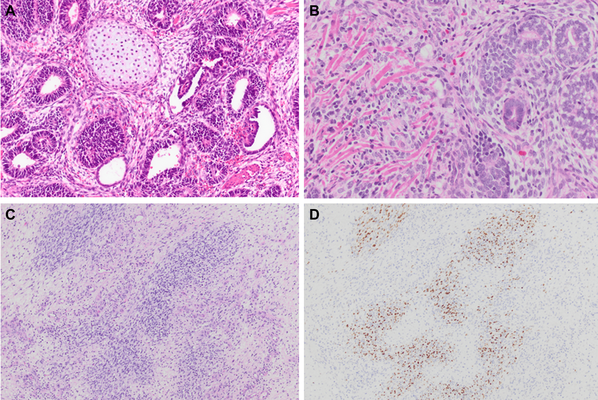 文献速递-DICER1相关的Wilms样肿瘤