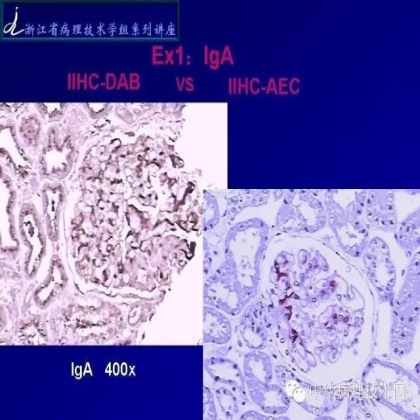 探讨免疫组织学在肾穿标本中的应用