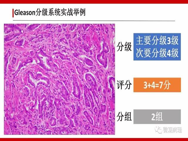 前列腺癌Gleason分级系统的前世今生