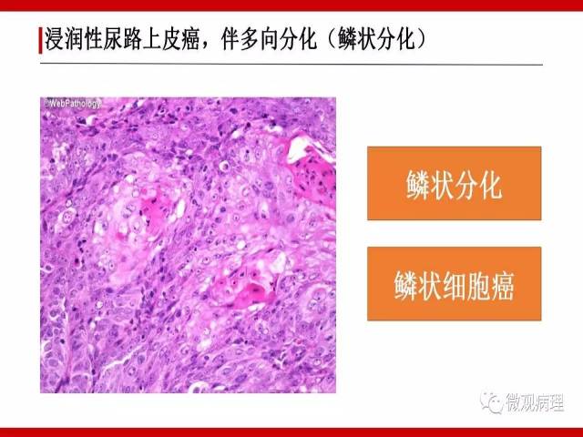 泌尿课程/浸润性尿路上皮癌病理学类型